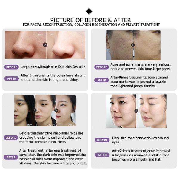 Sale promotion 3 years warranty 1000W input power co2 laser focus lens machine for acne scars