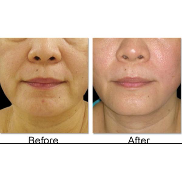 Hifu high intensity focused ultrasound for face lifting with vertical stand