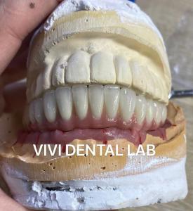 China Dental Implant Metal Ceramic Bridge On Titanium Abutments wholesale