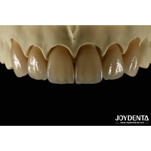 Bionic Development Leaves And Distinct Layers Of Zirconia All-Ceramic