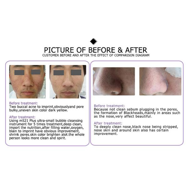 bottles dermabrasion ultrasonic therapy platinum machine as1 pen boosters korean edge hydrafacial