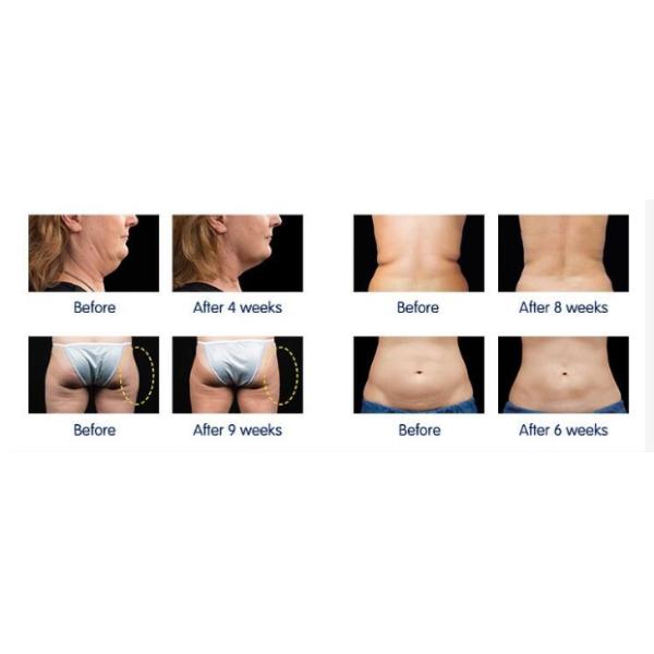 Radar Line Carve Hifu Skin Tightening Machine Spot Output Mode SMAS Contraction