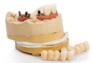 China Customized Dental Implant Replacement Durable Titanium Dental Implant wholesale