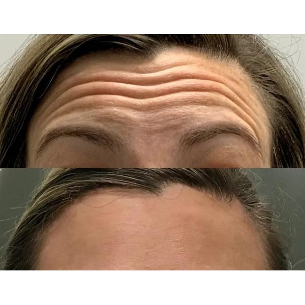 Safety Botulax 100 Units Target Wrinkles Fine Lines Removal