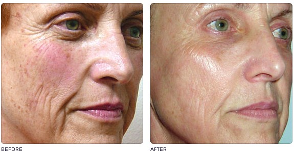 OEM design 4S multiple 2 display Beauty Machine-IPL&RF&E-light&Nd:YAG laser system