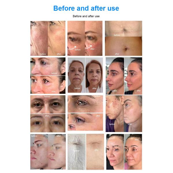 Skin Rejuvenation Wrinkle Removal Face Skin Lifting 12D Hifu Machine