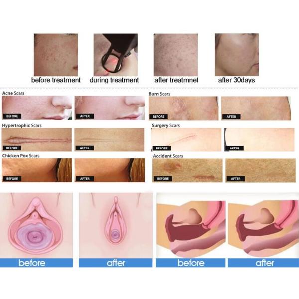 Commercial Fractional CO2 Laser Machine for Skin Resurfacing / Stretch Mark Removal