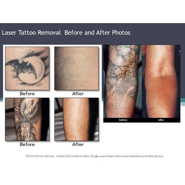 best tattoo removal Q-Swtiched Nd Yag Laser Machine FMY-I Tattoo Removal Machine