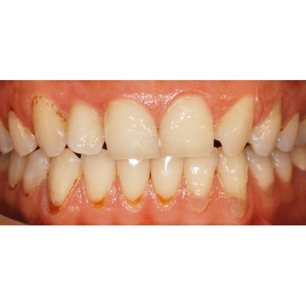 Translucent 600MPa 2.8g/cm3 Dental Zirconia Blocks Anterior Solid