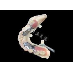 Customized Cast Partial Dentures Precision Metal Framework For Optimal Fit And