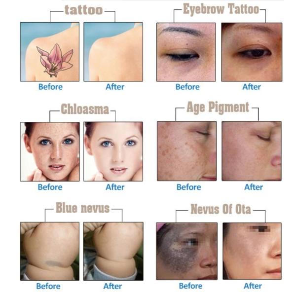 2026 Portable Diode Laser 808nm Painless Hair Removal Nd Yag Pico Laser Tattoo Removal Machine