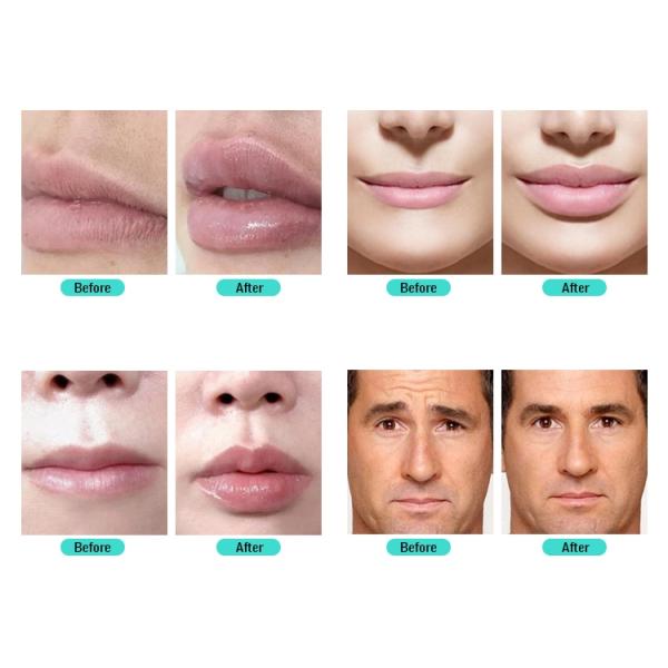 Cross Linked 24mg/Ml Revolax Fine Deep Sub-Q Hyaluronic Acid Fillers