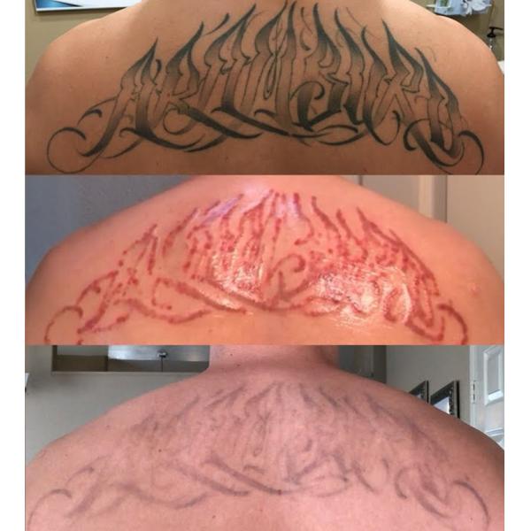 2026 Portable Diode Laser 808nm Painless Hair Removal Nd Yag Pico Laser Tattoo Removal Machine