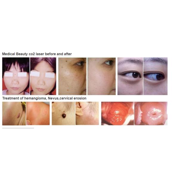 15W Surgical CO2 Laser Machine for Scar removal And Pigment Removal