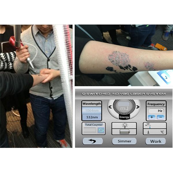 The New Listing Latest technology CE approved nd yag laser tattoo removal machine