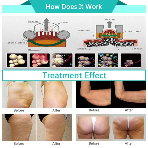 China new innovative product beauty salon use cellulite removal body shape vacuum roller slimming machine