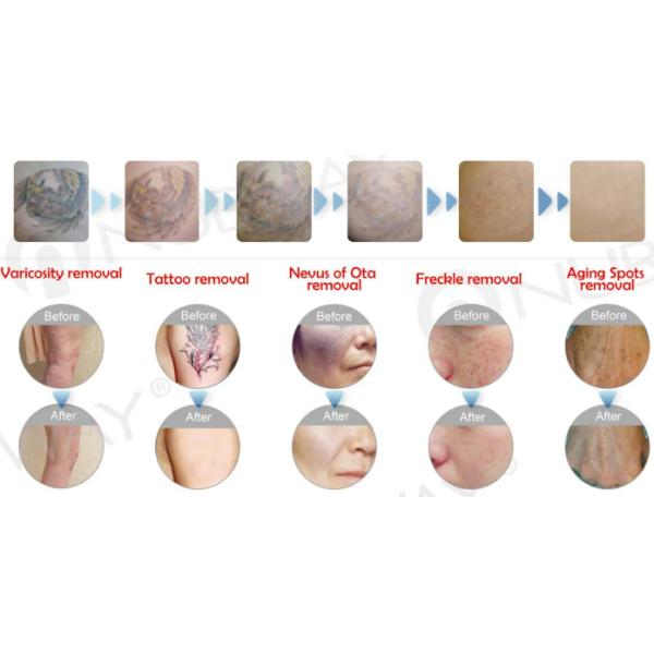 q switched 1064nm 532nm nd yag laser & Laser tattoo removal machine for sale