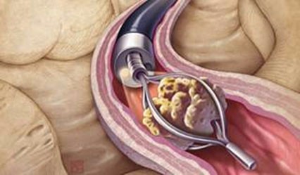 ERCP Disposable Stone Retrieval Basket With Spiral Shape Nitinol Stone Basket