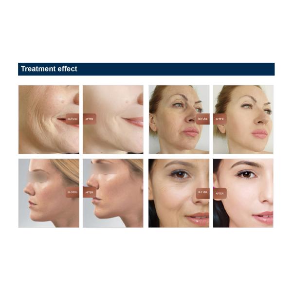 EMS Technology V-face Wrinkle Removal Anti Aging Machine for Portable Facial Firming