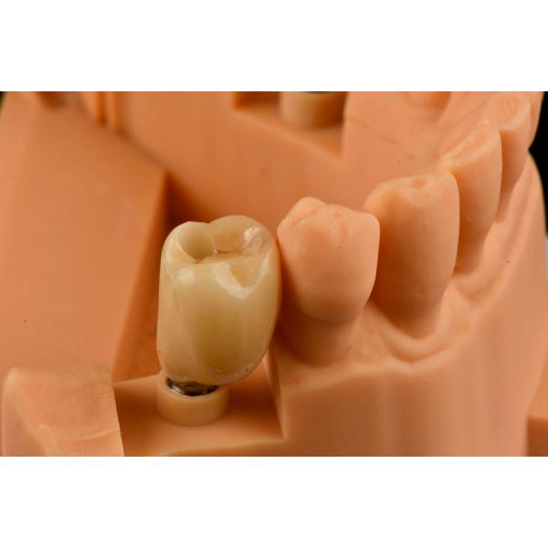 Internal Hex Connection Sandblasted Titanium Dental Implants Single Tooth