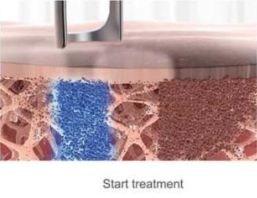 Colorful Pico Laser Tattoo Removal Machine 1500W Power For Beauty Salon