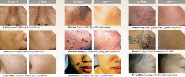 Orgin Factory Best 1064nm/532nm all color laser beauty machine for tattoo removal machine