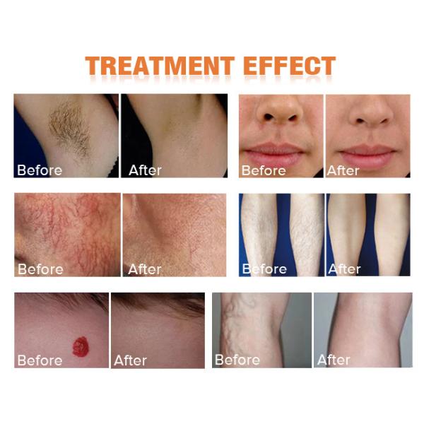 Nd YAG Alexandrite Laser Machine 1064 755 Laser Hair Removal Permanent