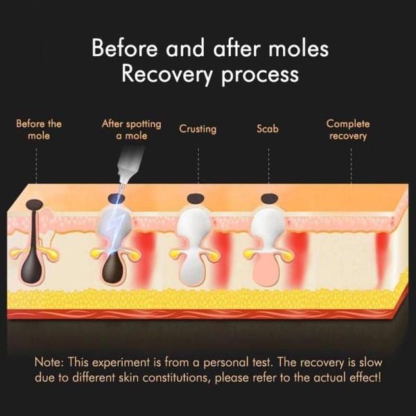 LCD Facial Skin Care Devices Tattoo Removal Plasma Mole Remover Pen SGS Approval