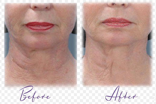 Hifu high intensity focused ultrasound for face lifting with vertical stand