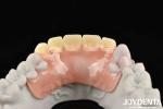 Elaborate Technology Framework Set Up Teeth Finish For Stable Oral Structure In