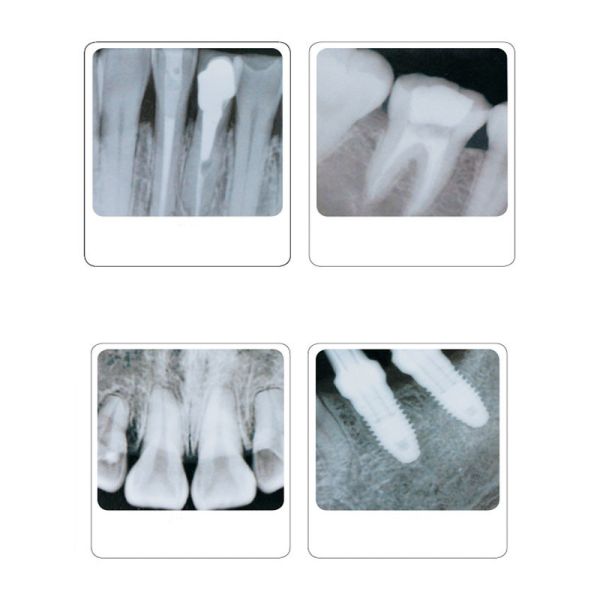 60KV 300kHZ Dental X Ray Machine Unit Portable Lightweight High Frequency