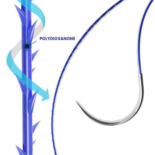 Henan Aile-Bi-directional Absorbable knotless barbed PDO suture disposable absorbable Suture widely used in the field of beauty