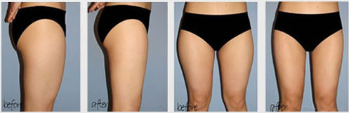 2015 New arrived HIFU high intensity technology body slimming machine