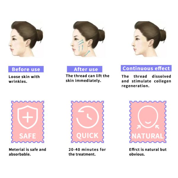 27g 30g PDO PCL PLLA Threads 25mm 38mm V Line Thread Lift