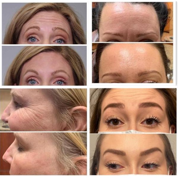 Wrinkle Removal Allergan 100 Units For Face Lift Injection Anti Age