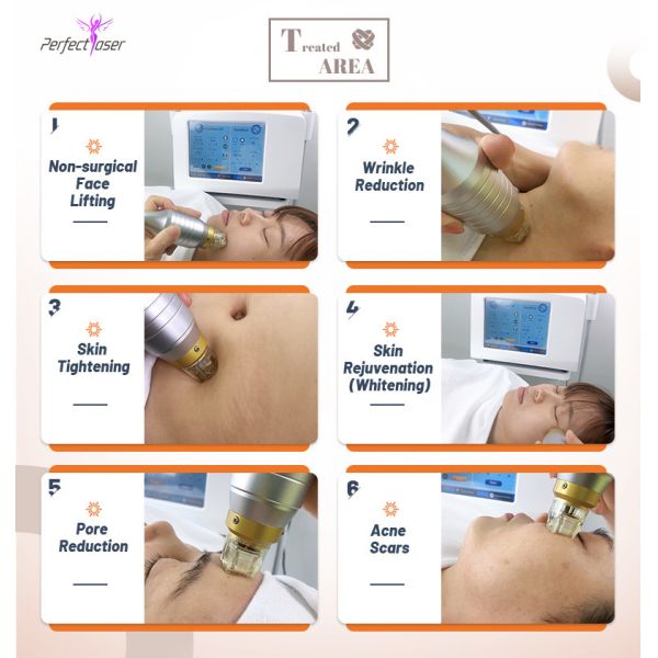 Skin Lifting RF Microneedling Machine Ance Stretch Marks Removal Machine