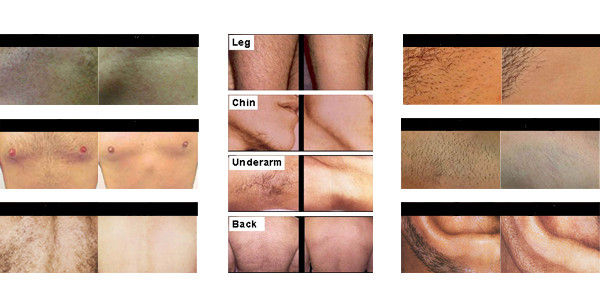 808nm lumenis diode laser hair removal machine price from manufacturer